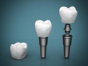 What Dental Implant Is Right For Me