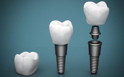 Guide on Dental Implants: What Dental Implant Is Right For Me?