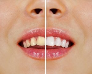 Bondi Dentist Tips Over-the-Counter vs Professional Teeth Whitening