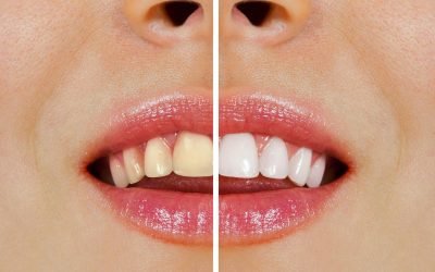 Dental Tips: Over-the-Counter vs Professional Teeth Whitening