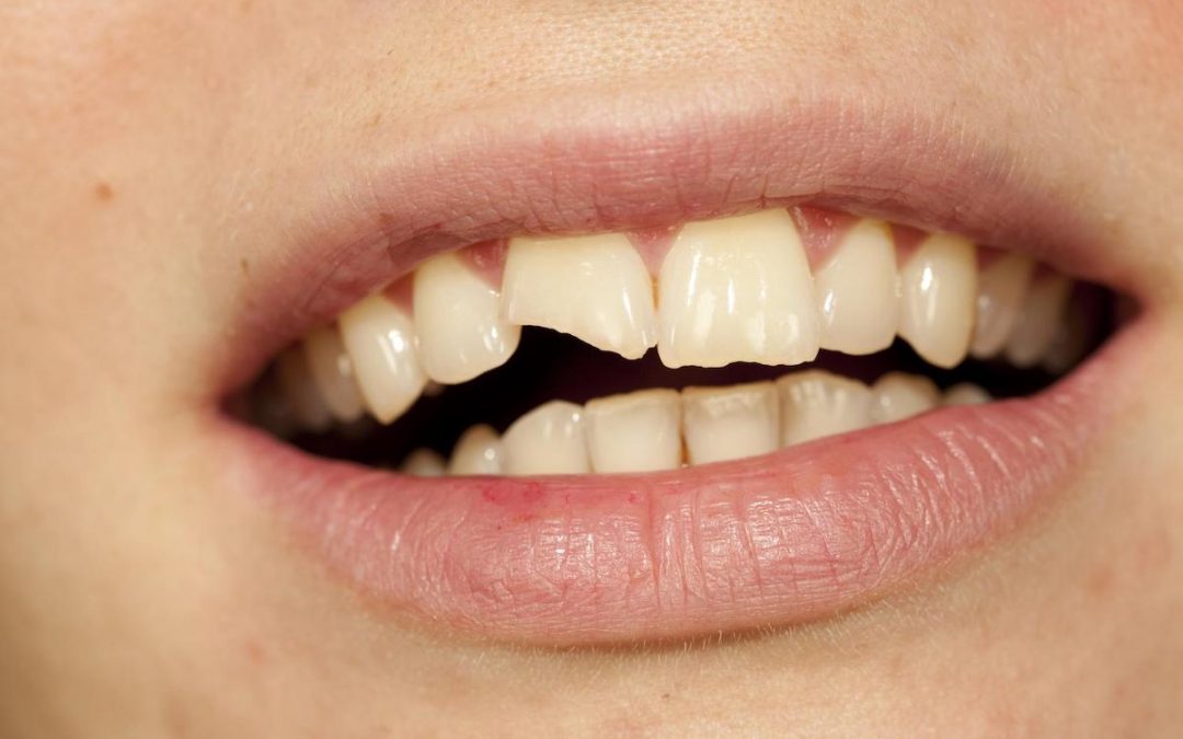 I Chipped My Dental Implant – Is It Serious? What Can I Do?