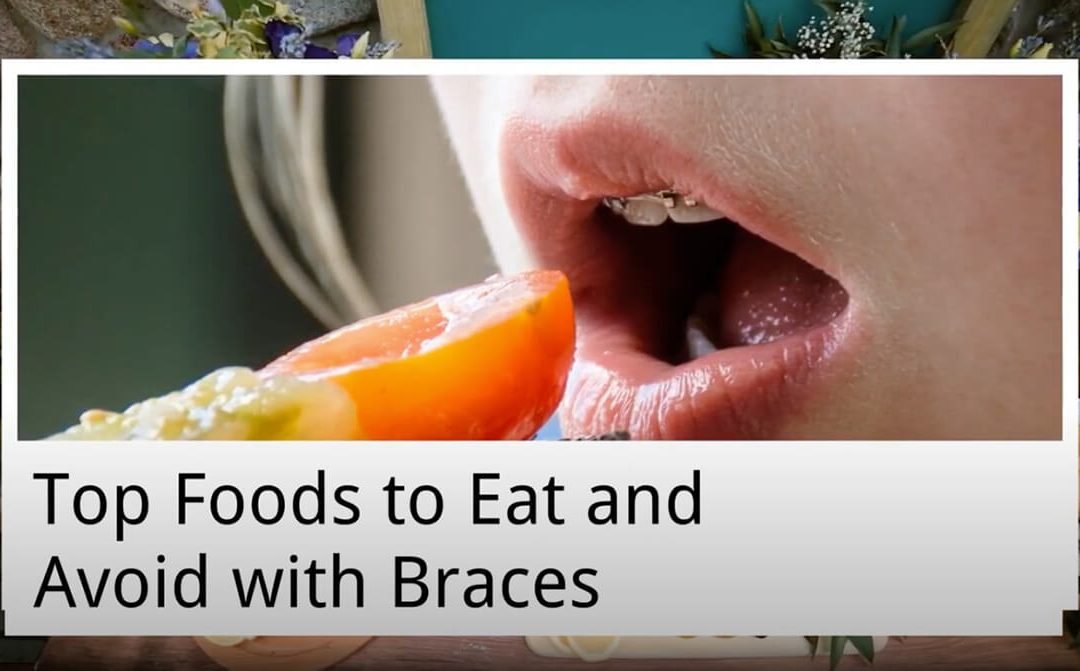 Top Foods to Eat and Avoid with Braces from Bondi Dental