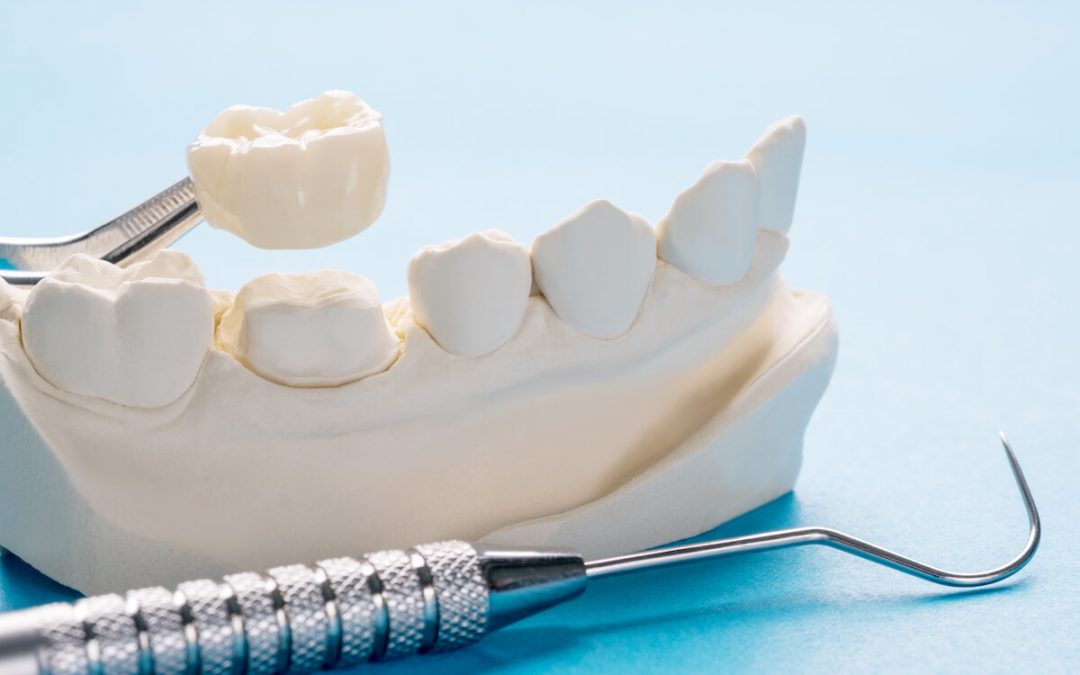 How Long Will Dental Crowns Last? Answers from Bondi Dental