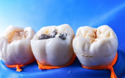 How to Pick the Right Dental Fillings in Bondi