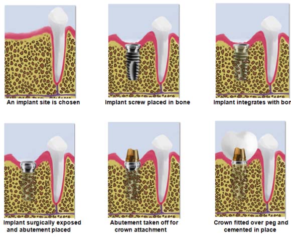 Bondi-Dental-Dental-Implant-Procedure-Dentist-Bondi