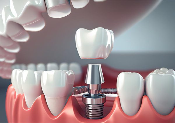 what are dental implants bondi beach