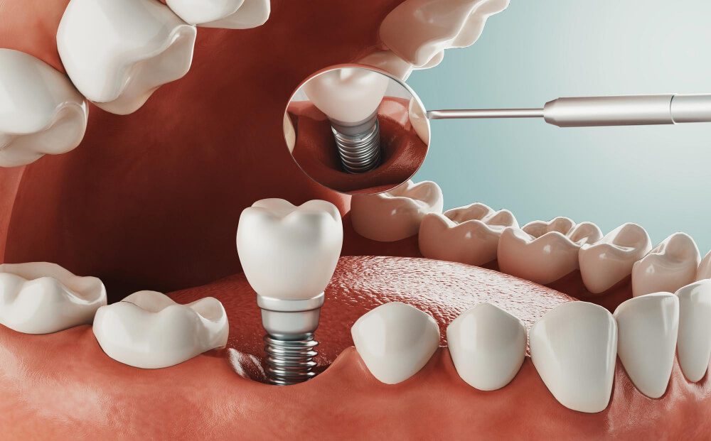 Dental Implants Bondi: Advantages of Permanent Tooth Replacement