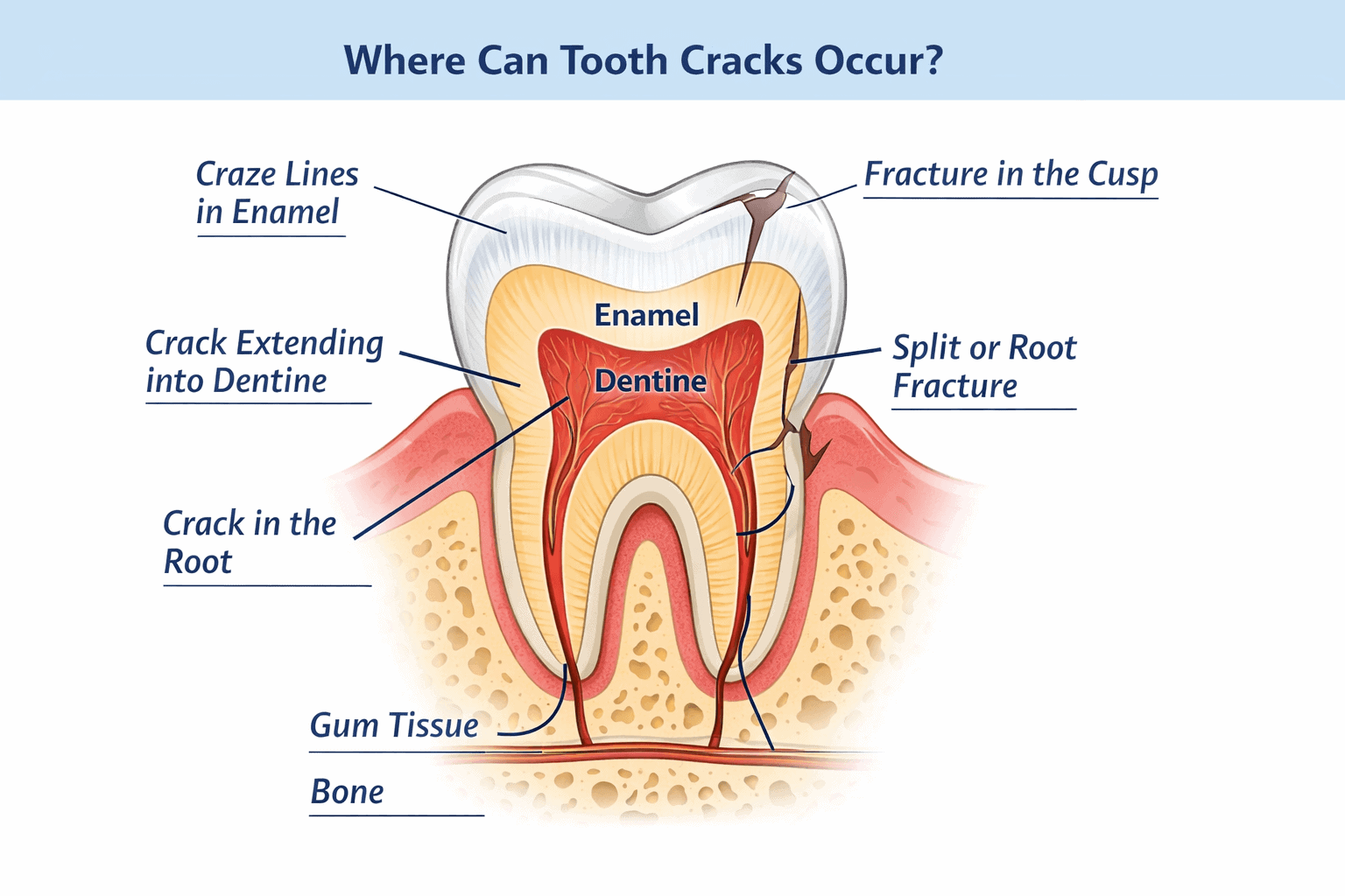 Diagram showing tooth cracks from enamel lines tBD ist imageo deeper fractures reaching the root in Bondi Beach