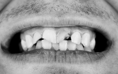 Crack Tooth Repair – 5 Procedures To Fix a Cracked or Broken Tooth