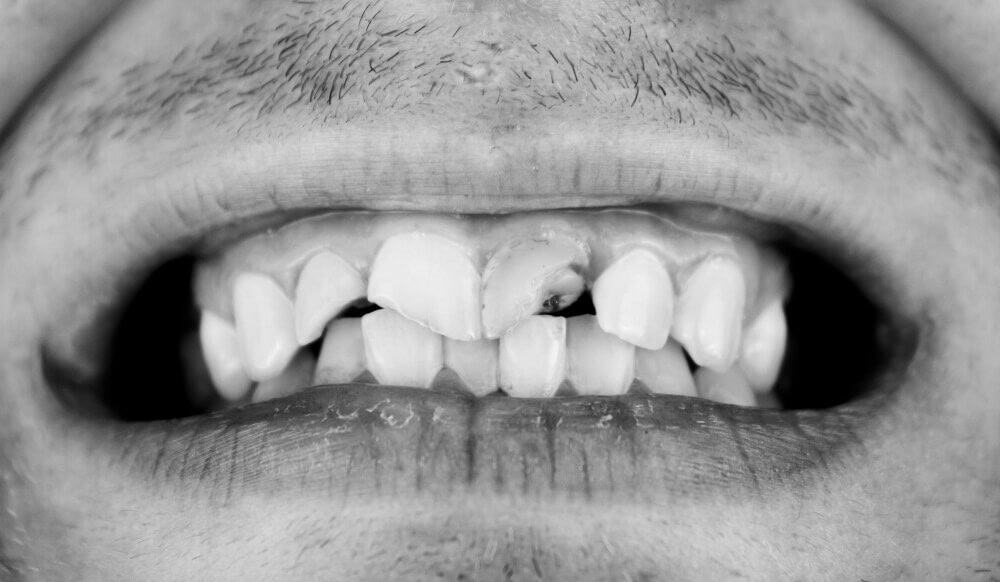 Crack tooth repair Bondi Beach