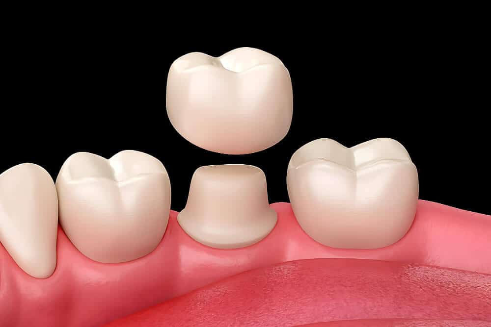 Same-day dental crown Bondi Beach