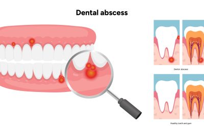 What Does a Tooth Abscess Look Like? Understanding the Causes and Treatment Options