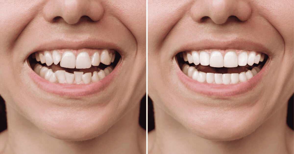 Before and after porcelain veneers Bondi Beach