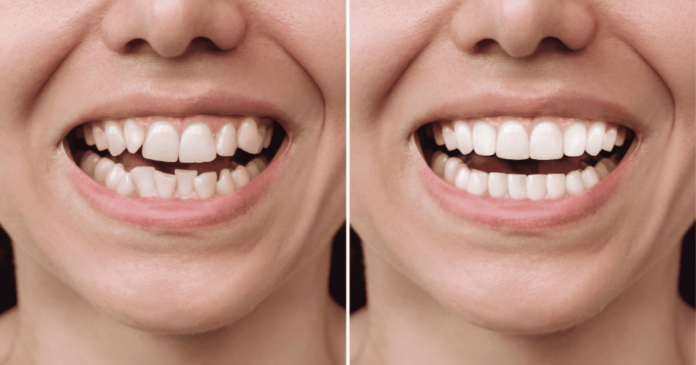 Before and after porcelain veneers Bondi Beach