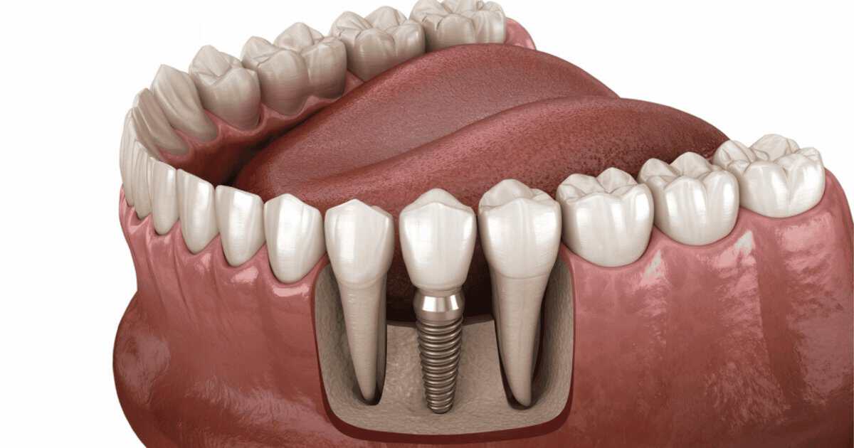Dental implant jawbone Bondi Beach