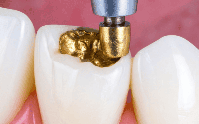 What Are Dental Fillings and When Do You Need One?