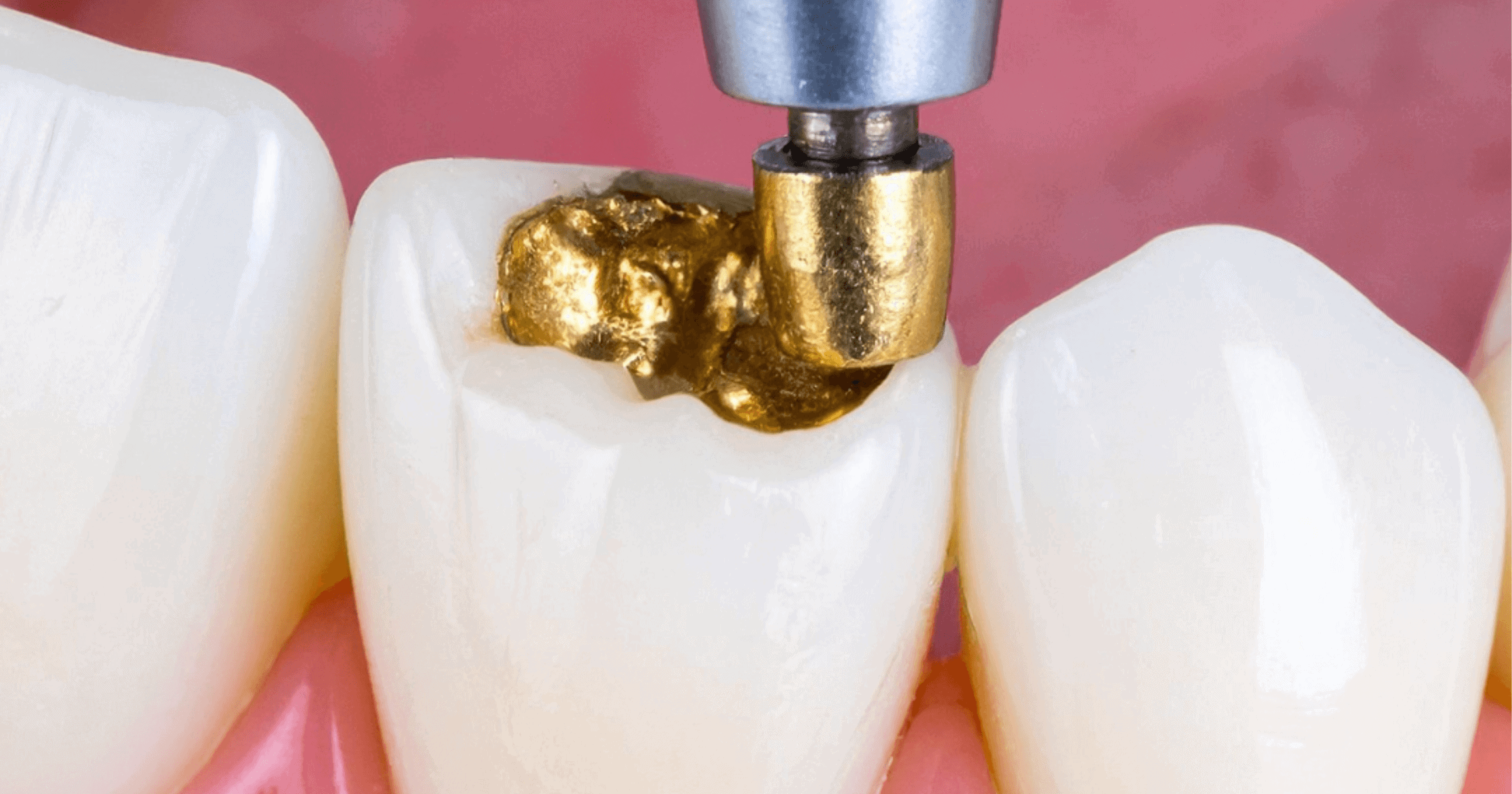 What Are Dental Fillings and When Do You Need One