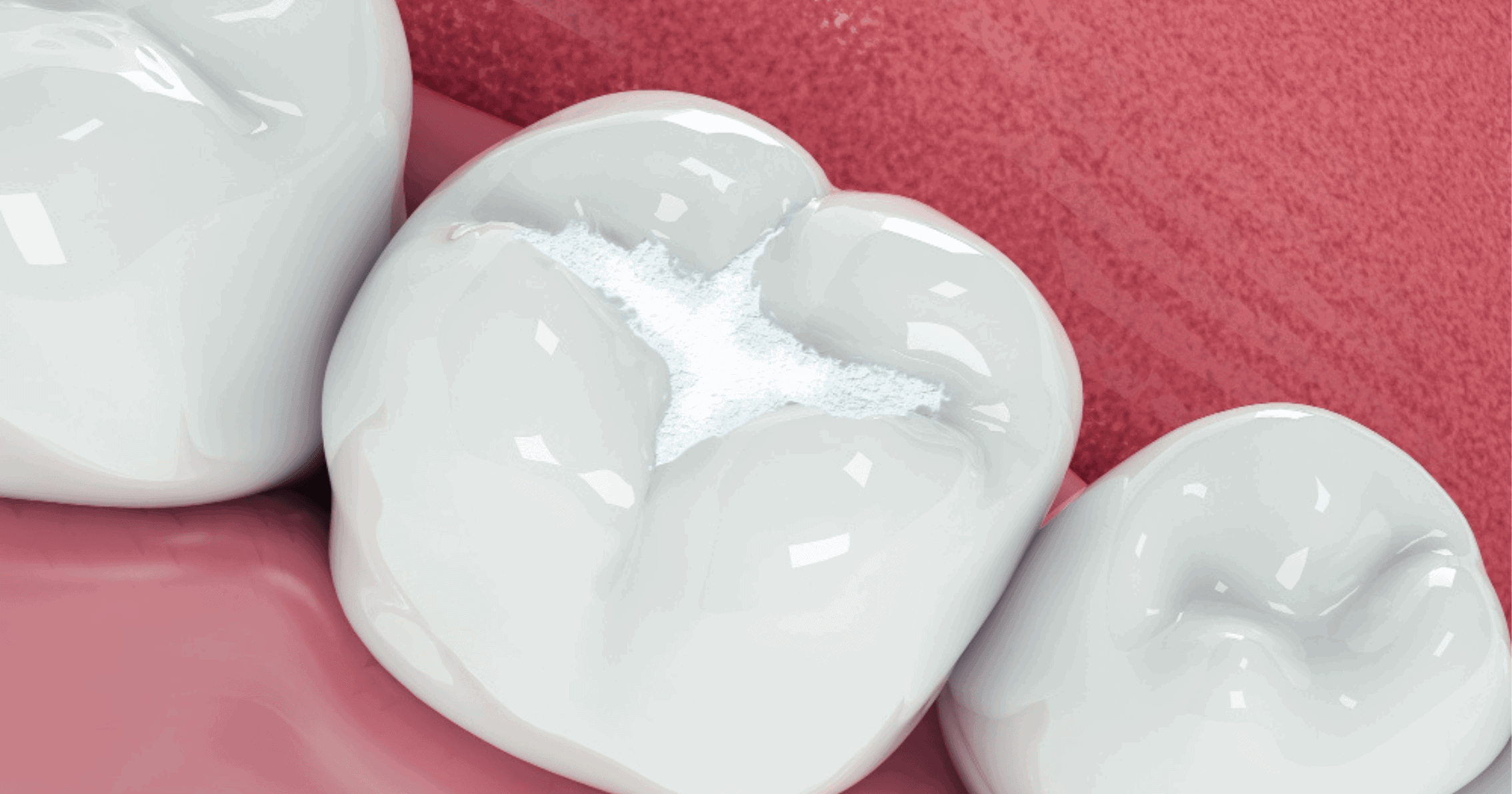 White composite tooth filling Bondi Beach