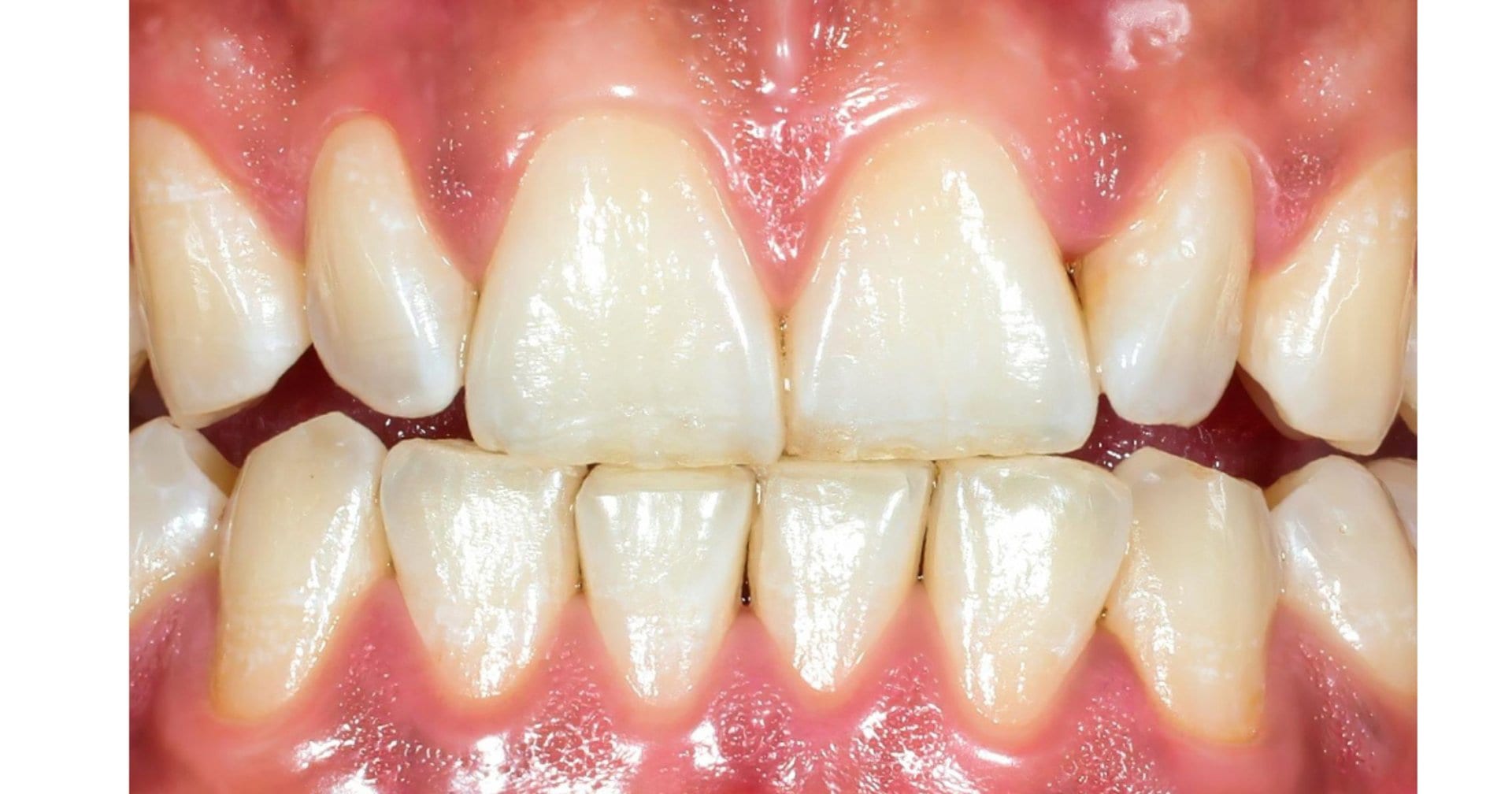 Early signs of gum recession visible at the gumline in Bondi Beach