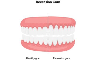 What Receding Gums Look Like and Why They Happen