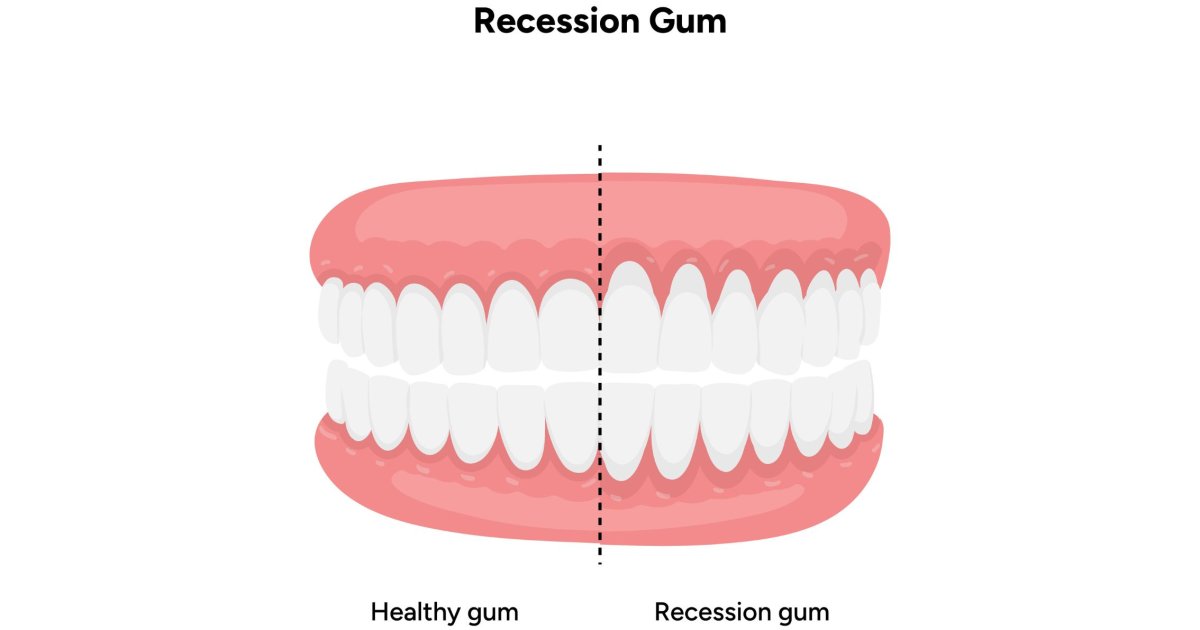 Illustration comparing healthy gums with receding gums in Bondi Beach
